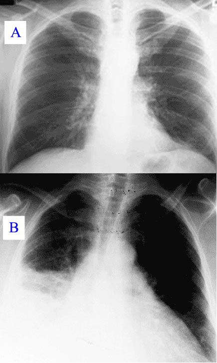 Röntgenbild von einer gesunden Lunge und einer Lunge, die Pneumonia, d.h., Lungenentzündung, zeigt.